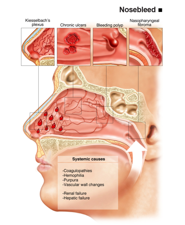 Infografis epistaksis